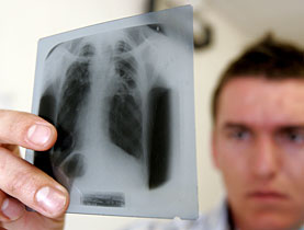 20080507-tuberculosis